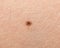 Mole on the human skin