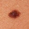 Mole - Nevus