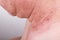 Mole removed via skin graft procedure leaving scar