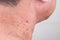 Mole removed via skin graft procedure leaving scar