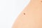 Mole to be removed. Woman body with dangerous bulging mole on a white background. Verrucous nevus. Copy space