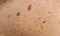 Moles and birthmarks on the skin of elderly women