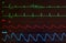 Monitor with Short Run of Ventricular Tachycardia