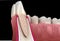 Morphology of maxillary lateral incisor tooth and gum. Medically accurate dental 3D illustration