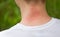 Mosquito bites. Girl with blond hair, sitting with his back to turn. Close-up of visible red, swollen neck skin from mosquito bite