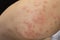 Mosquito bits skin of man`s elbow, creating a large area of bump, itching, swelling, soreness, and redness. hand cannot help