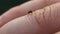 Mosquito on human finger