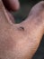 Mosquitoes are biting human skin