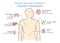 Most common sites and symptoms of Cancer Metastasis.