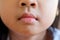 Mouth Asian girl with allergies lip licking dermatitis