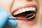 Mouth checkup oral hygiene. white healthy woman teeth and dentist mirror