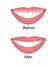 Mouth with a high smile line or gummy smile before and after the orthotropics, orthotropics or botox injections