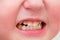 Mouth, lips and teeth of an angry toddler baby, close-up. Macro photo o