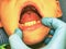 Mouth with retainer Braces for Teeth. Orthodontics Dental Methods