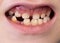 Mouth and smile of a child without one tooth. Loss of milk teeth in children, close-up