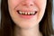 Mouth of young scary woman with yellow bad teeth smiling looking at camera.