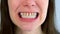 Mouth of young woman with yellow bad teeth preparing to install ceramic veneers.