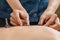 Moxibustion Therapy â€“ Traditional Chinese Medicine