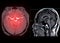 MRA Brain  axial MIP view showing cerebral artery