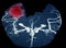 MRA brain or Magnetic resonance angiography image  MRA  of cerebral artery in the  hemorrhage in brain