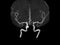 MRA Brain or Magnetic resonance angiography MRA of Vessel in the brain turn around on the screen. MRA Brain MIP view for evaluat