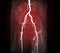 MRA Femoral artery red zone.