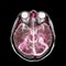 MRA (magnetic resonance angiography) of brain for stroke patient .