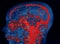 MRA AND MRV OF BRAIN Finding:Bilateral territorial muscles to the cortex and subcortical of the parietal and low hemispheres