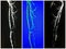 Mra superficial femoral artery occlusion collage