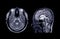 MRI of the brain axial and Coronal plane.