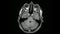 MRI Brain Axial Navigation
