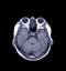 MRI of the brain Axial  T1 view