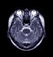 MRI of the brain Axial T2