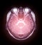 MRI of the brain Axial T2