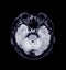 MRI of the brain Axial T2 flair