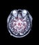 MRI brain Axial  T2 technique  with mra brain mix image.