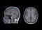 MRI  brain compare axial and sagittal plane