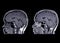 MRI  brain  compare sagittal t1w non gadolium and with gadolinium