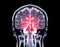 MRI brain Coronal T2W and MRA Brain fusion  in Coronal view