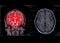 MRI brain Coronal T2W plane for detect stroke disease .