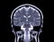 MRI Brain Coronal t2W view for detect a variety of conditions of the brain such as cysts, tumors, bleeding   isolated on the