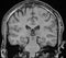 MRI Brain Coronal View