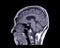 MRI of the brain sagittal T1 view