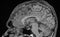 MRI Brain Sagittal View