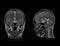 MRI  brain scan  Compare Coronal and sagittal plane for detect  Brain  diseases sush as stroke disease, Brain tumors and