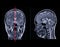 MRI  brain scan  Compare Coronal and sagittal plane for detect  Brain  diseases sush as stroke disease, Brain tumors and