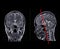 MRI  brain scan  Compare Coronal and sagittal plane for detect  Brain  diseases sush as stroke disease, Brain tumors and