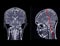 MRI  brain scan  Compare Coronal and sagittal plane for detect  Brain  diseases sush as stroke disease, Brain tumors and