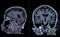 MRI  brain scan Sagittal and coronal view with reference line for detect  Brain  diseases sush as stroke disease, Brain tumors and