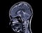 MRI  brain scan  sagittal plane for detect  Brain  diseases sush as stroke disease, Brain tumors and Infections